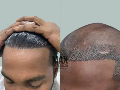BeforeafterImage