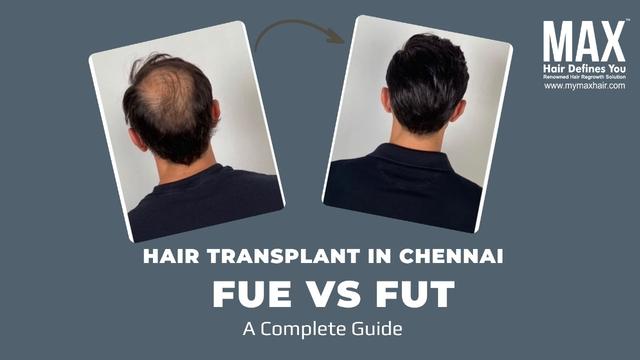 Hair Transplant in Chennai: FUE vs FUT: A Complete Guide Image