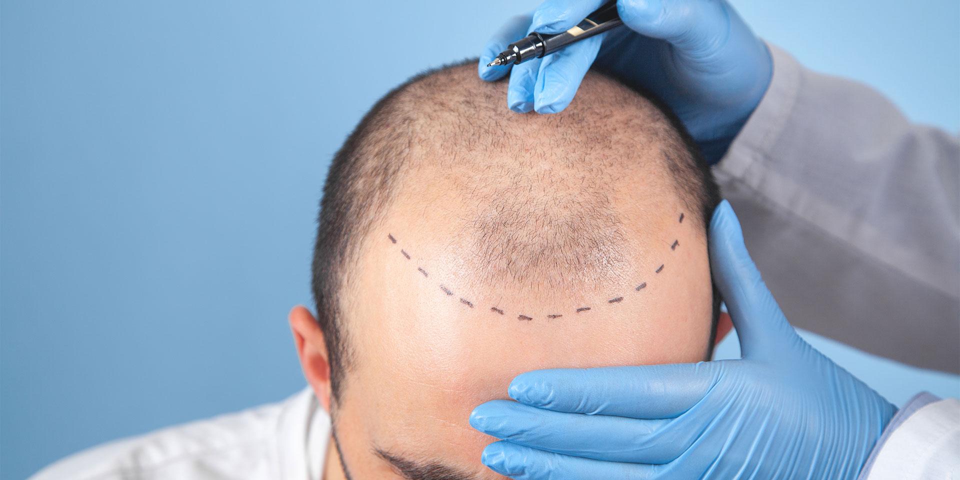 Basic Hair Transplant