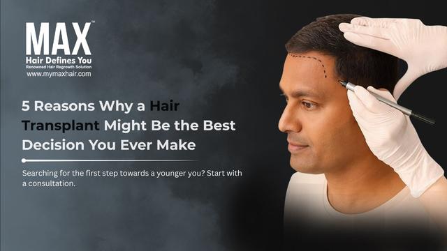 5 Reasons Why a Hair Transplant Might Be the Best Decision You Ever Make Image
