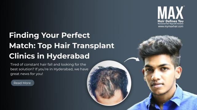 Finding Your Perfect Match: Top Hair Transplant Clinics in Hyderabad Image