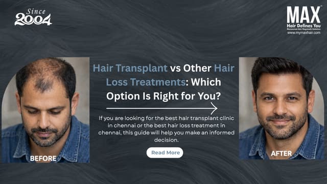 Hair Transplant vs Other Hair Loss Treatments: Which Option Is Right for You? Image