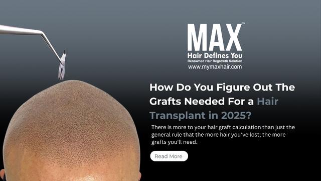 How do you figure out the grafts needed for a hair transplant in 2025? Image