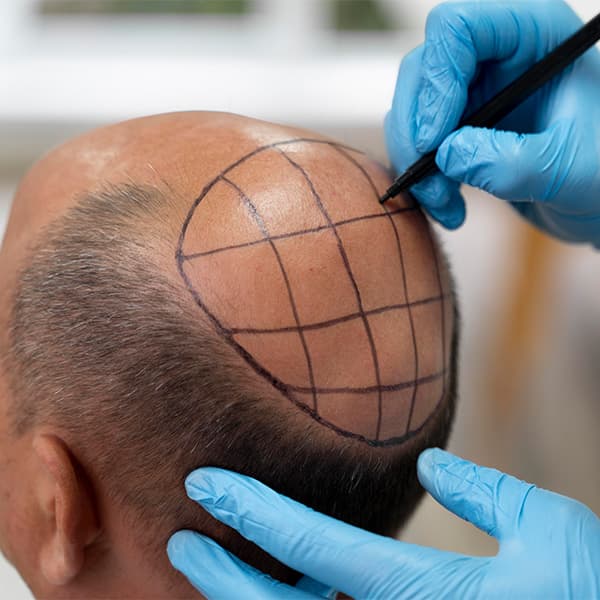 Basic Hair Transplant