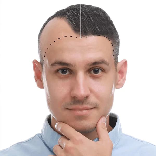 IGM Hair Transplant