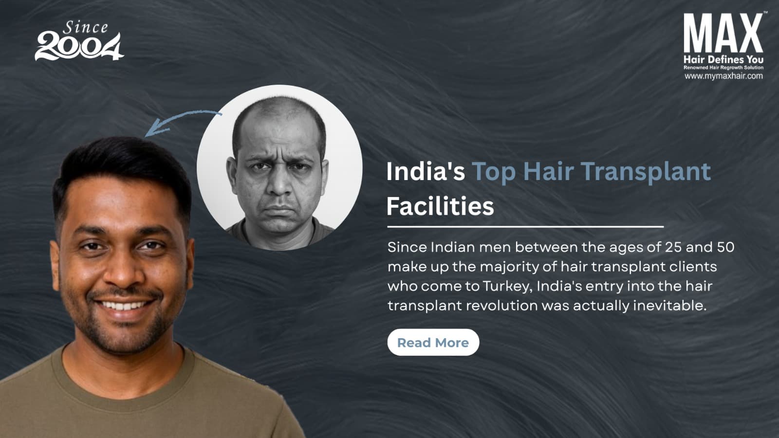 Hair Care Clinic india Hair Trasplant clinic in India