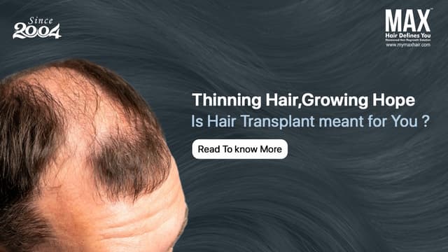 Is Hair Transplant the Right Solution for Thinning Hair? Image