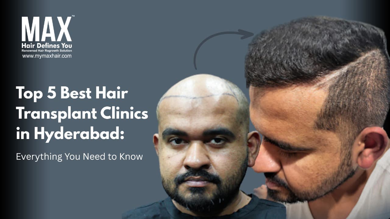 Top 5 Best Hair Transplant Clinics in Hyderabad: Everything You Need to Know BlogImage