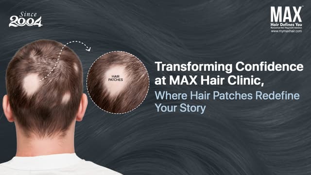 Rediscover Your Confidence with Hair Patch Solutions at MAX Hair Clinic Image