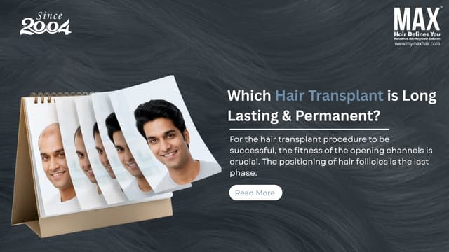 Which hair transplant is long-lasting & permanent? Image